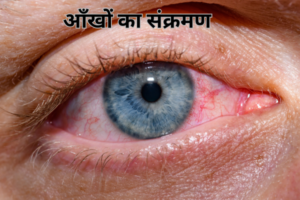 कंजेक्टिवाइटिस