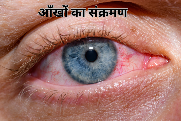 कंजेक्टिवाइटिस